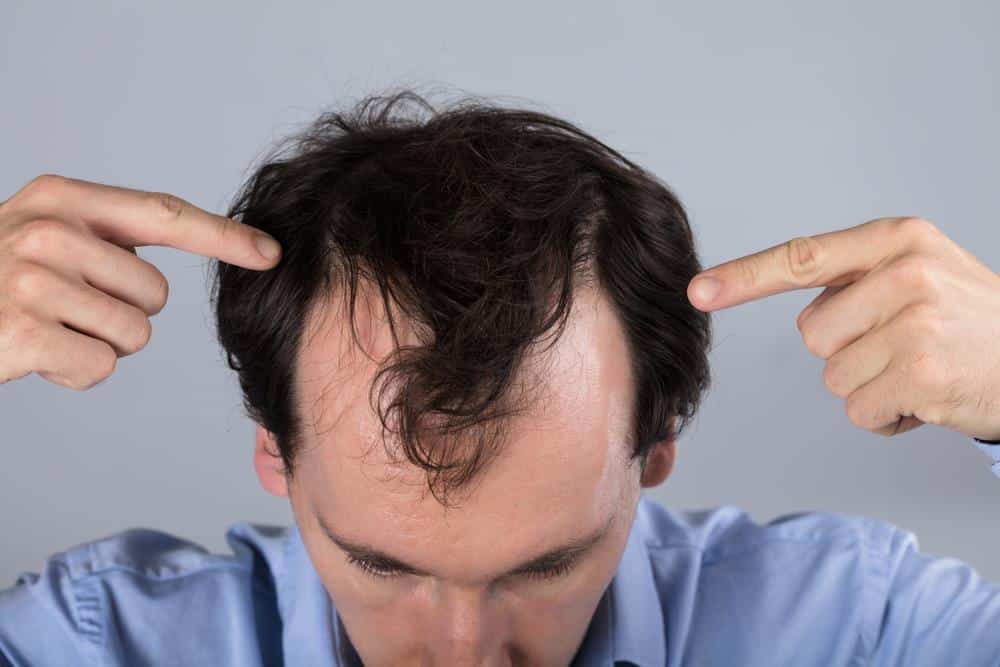 Przeszczep włosów – czy to dobry pomysł? Kraj, zemptypost, zPAP