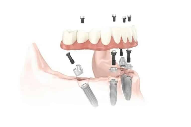 Implanty zębowe całej szczęki metodą All on 4