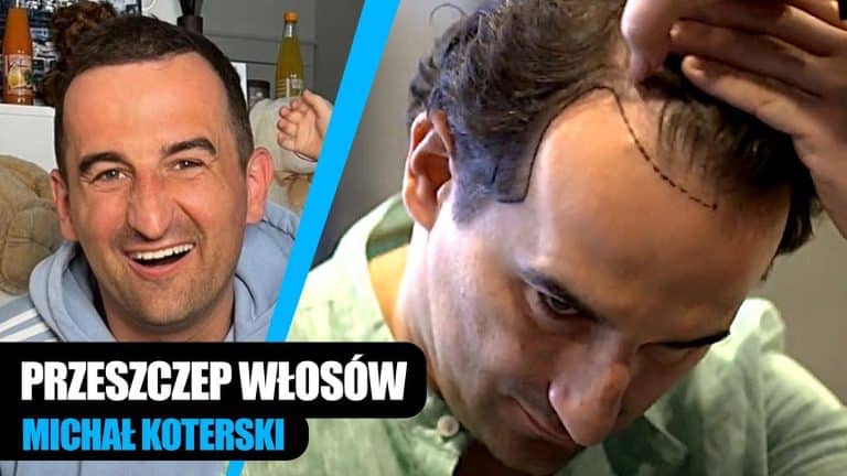 Celebryci i znani sportowcy zaufali FlyMedica – Przeszczep włosów w Turcji nie tylko dla gwiazd