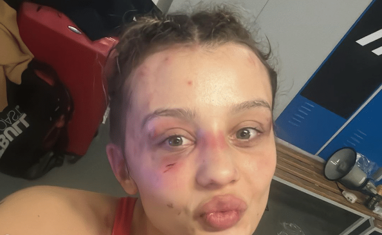 Znana olsztynianka opublikowała zdjęcia. Ma całą poobijaną twarz