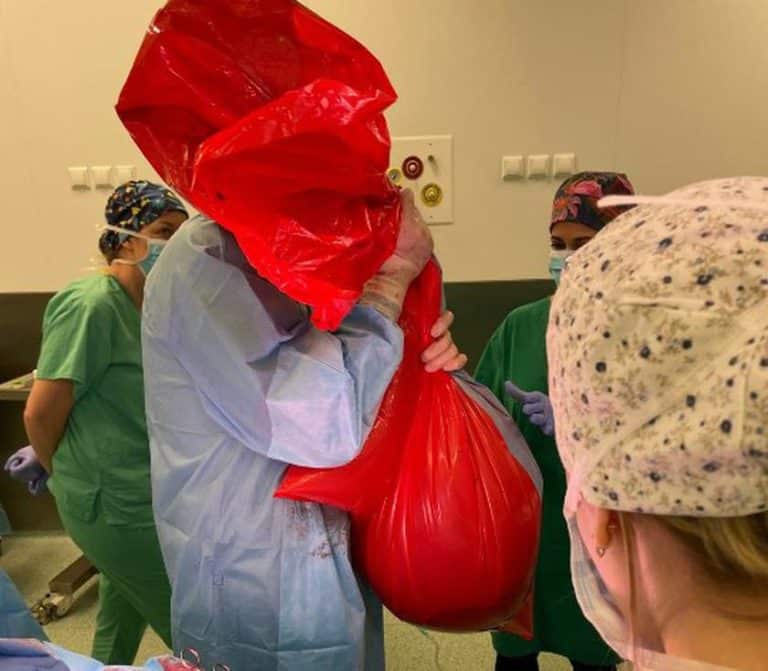 Niezwykła operacja w Iławie. Usunięto 14 kg guz jajnika