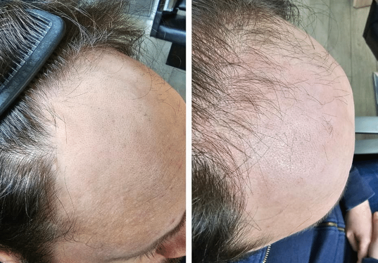 Laser, który daje nadzieję na odratowanie włosów – już w Olsztynie!