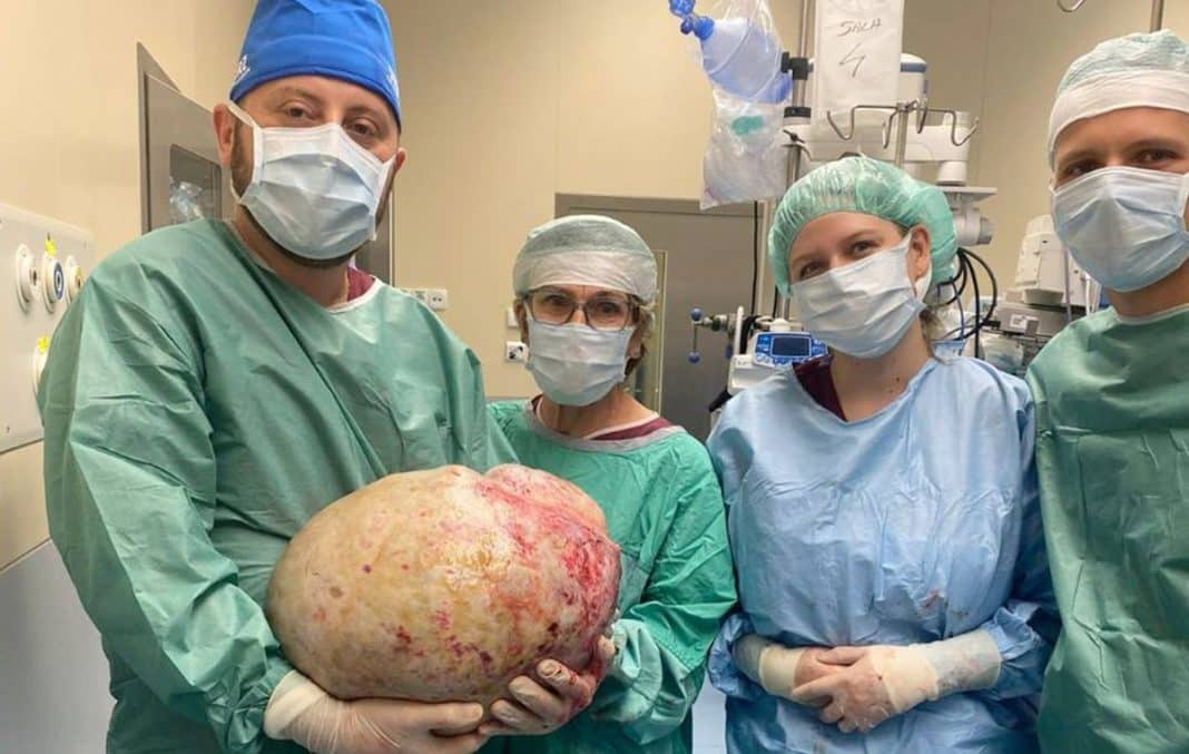 usunięcie 20 kg guza