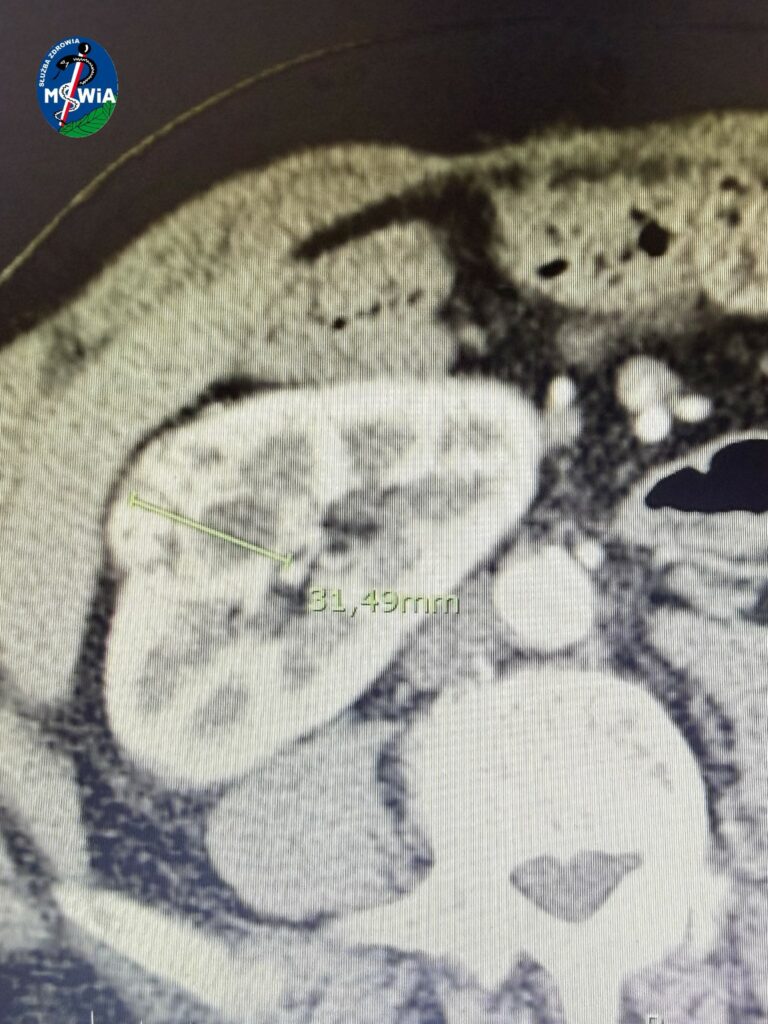 Pierwsza taka operacja w regionie zakończyła się spektakularnym sukcesem. - W Olsztynie robot przeprowadził przełomowy zabieg. Pierwsza taka operacja w regionie