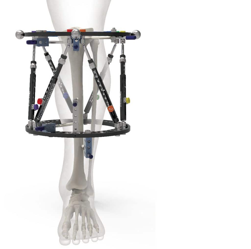 Urządzenie ortopedyczne na tle modelu ludzkiej kończyny, używane do korekcji i wydłużania kończyn.